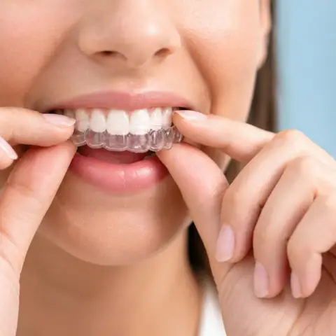 Close view of a smiling woman pressing a clear aligner onto her upper teeth